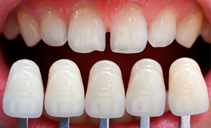 Винирование зубов: все, что нужно знать